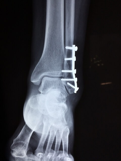 röntgen fot